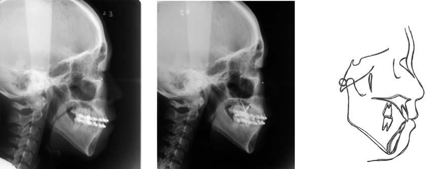 The patient refused orthognathic surgery. The treatment plan was extraction of 36 and 46 with microscrew anchorage to intrude the posterior dentoalveolar region.