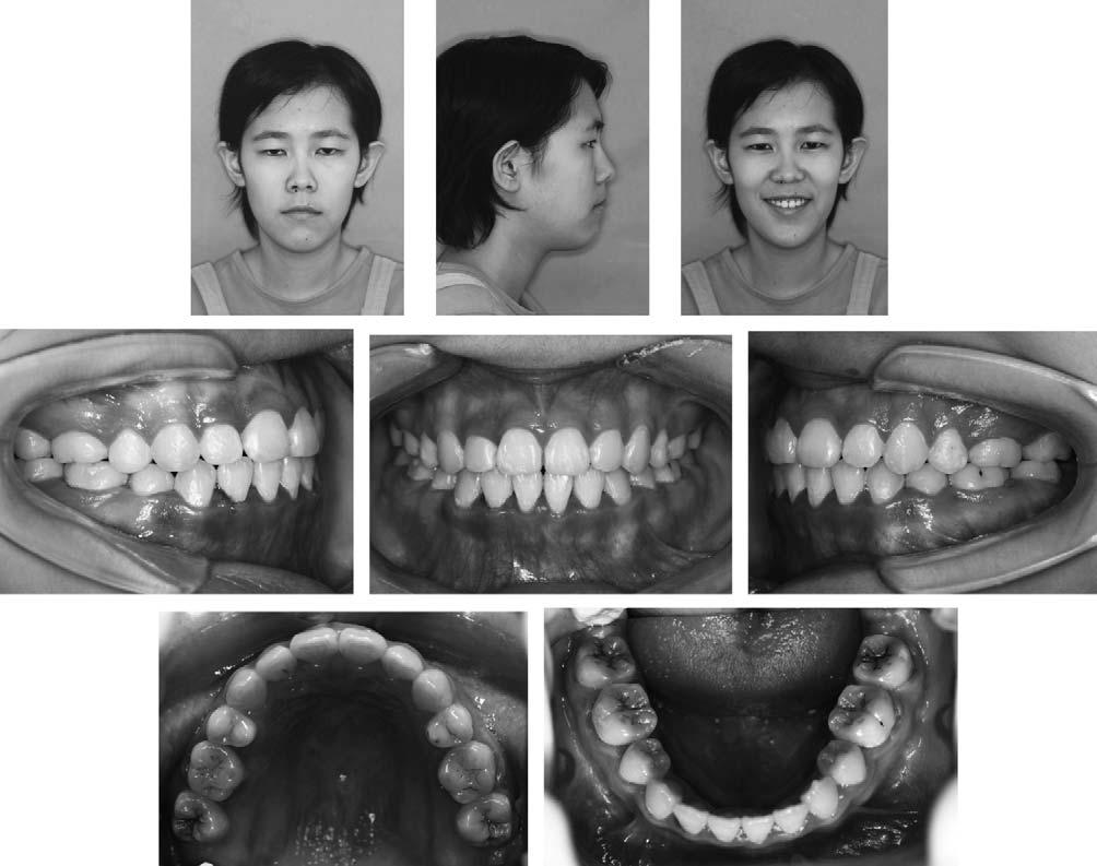 MICROSCREW ANCHORAGE 55 Figure 13. Posttreatment facial and intraoral photographs (case 2).