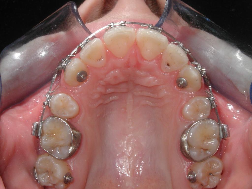 Clin. Orthod. 30:283-287, 1996. 5. Thompson, R.E. and Way, D.C.: Enamel loss due to prophylax is and multiple bonding/debonding of orthodontic attachments, Am. J.