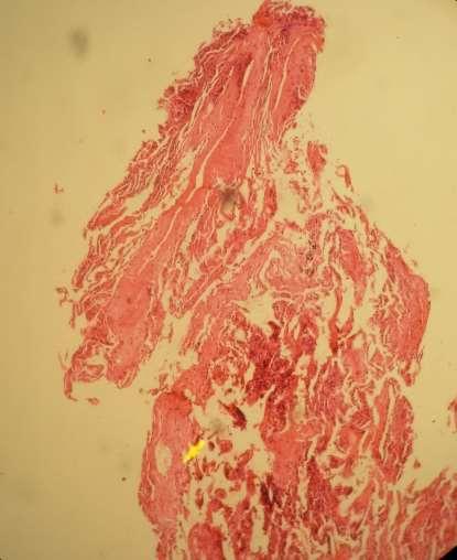 Multiple Thickened Blood Vessels