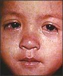 Measles Symptoms Prodrome (2 4 days) Fever, cough, corzya, conjunctivitis, malaise Within 2 4 days after
