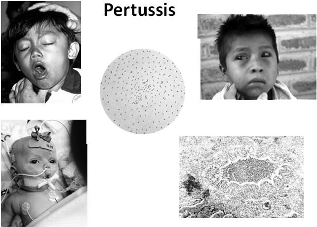 Pertussis Pertussis Vaccine Taxonomy DTP Old whole cell diphtheria, tetanus, and persussisvaccine for children.