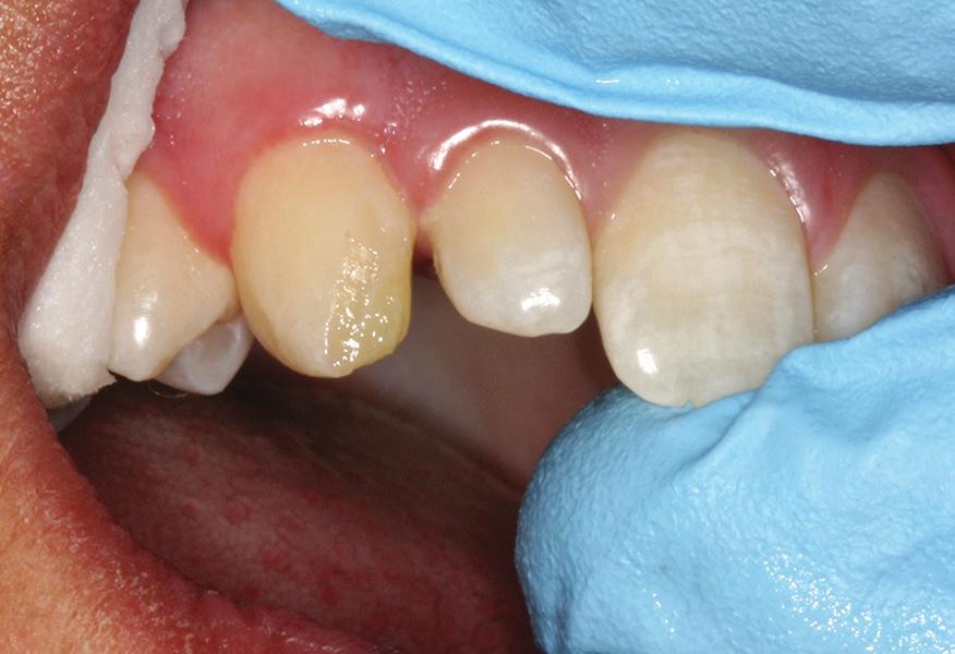 White, orange and brown tints were painted over the second increment to characterize and mimic the shade patterns of the adjacent teeth (Shade modification tints, SDI).