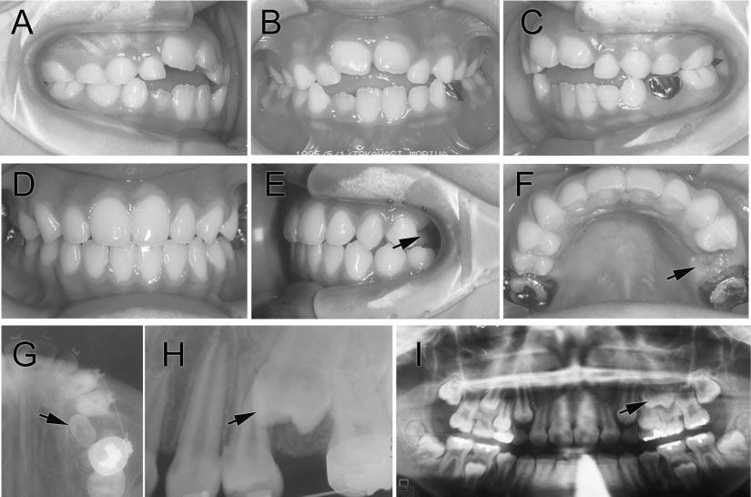 ORTHODONTIC IMAGING USING LIMITED CONE BEAM CT 897 FIGURE 2. Case 1: (A,B) Oral photograph in first visit. (D F) Oral photograph after first phase treatment. (G) Panoramic radiography.
