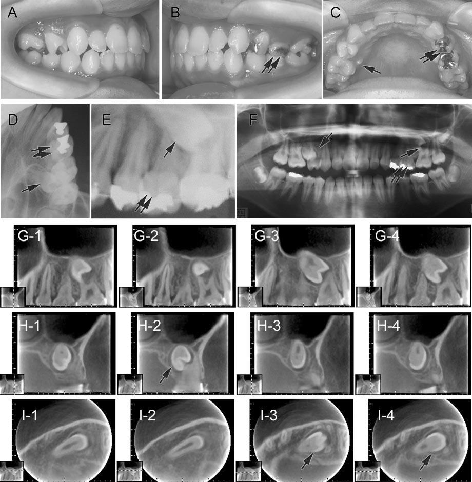 ORTHODONTIC IMAGING USING LIMITED CONE BEAM CT 899 FIGURE 4. Case 2: (A C) Oral photograph. (D) Occlusal radiograph. (E) Dental radiograph. (F) Panoramic radiography. (G 1 4) Sagittal images.