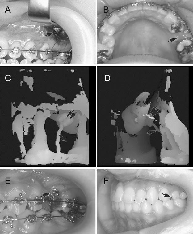 900 NAKAJIMA, SAMESHIMA, ARAI, HOMME, SHIMIZU, DOUGHERTY FIGURE 5. Case 2: (A) The surgical fenestration and retraction of impacted tooth. Single arrows indicate impacted tooth.