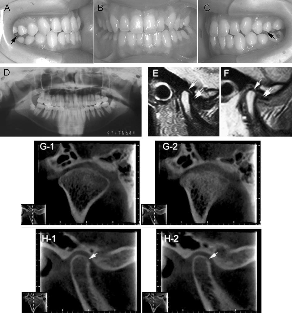 ORTHODONTIC IMAGING USING LIMITED CONE BEAM CT 901 FIGURE 6. Case 3: (A C) Oral photograph. (D) Panoramic radiography. (E) T1 magnetic resonance image (MRI) of left temporomandibular joint (TMJ).