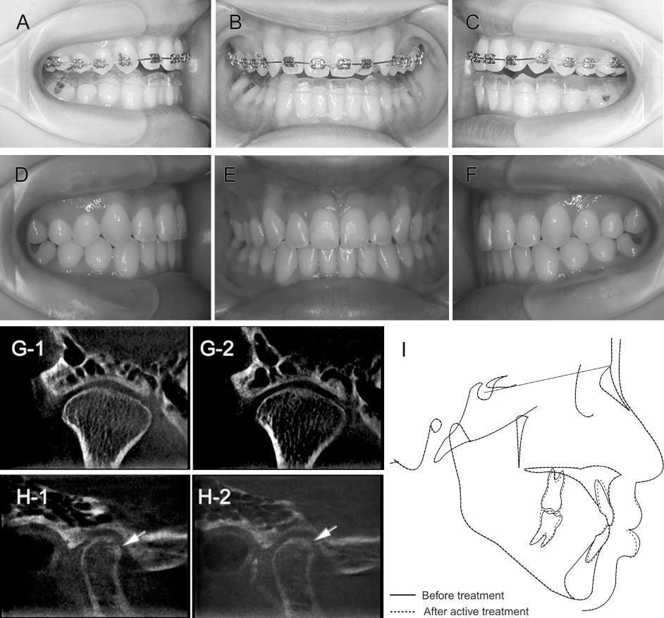 902 NAKAJIMA, SAMESHIMA, ARAI, HOMME, SHIMIZU, DOUGHERTY FIGURE 7. Case 3: (A C) Oral photograph during orthodontic treatment. The patient was wearing a stabilization-type splint.