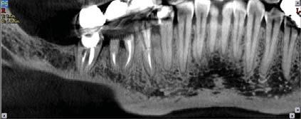 New York University College of Dentistry Hi Res Zoom Figure 5 Figure 6 Proper assessment for Implants requires the visualization of
