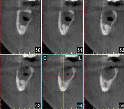 Maxillofacial Surgery Only a 3D scan can demonstrate the exact individual anatomy, define anatomical structures, and motivate the discussions that lead