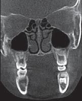 bone buccal cone beam scanners produce many to the molar roots, so that
