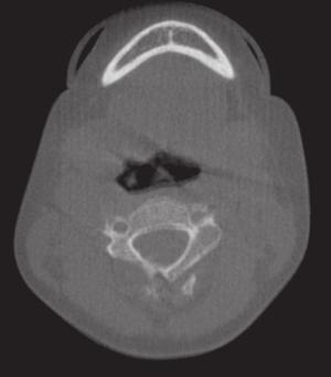 (a) Figure 1.14. (a) Coronal and sagittal views showing white ring artifacts (black arrow).