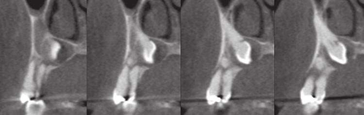 maxillary right second premolar (black arrow)