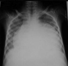 Case N 6 Chest X ray Typical aspect of a very important pericardial effusion,. The left and right cardiac edges are nearly symetric with overlap of the 2 hili.