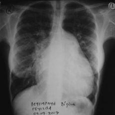 Case N 7 Chest X ray: typical «mitral silhouette» with dilatation of the left middle arch of mediatinum silhouette, vascular hilar hypertrophy and