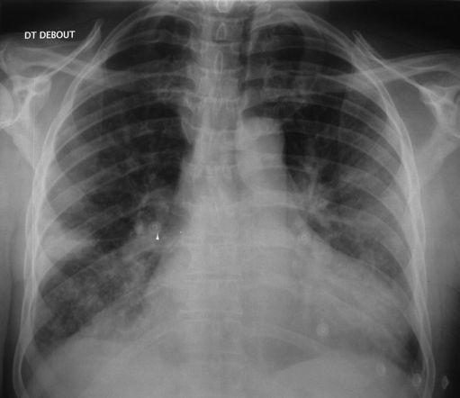 Case N 13 Man 46 years old, cough and exercice dyspnea, tachycardia, and past history