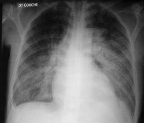 Case N 3 Chest Xray: cardiomegaly ( but in case of CXR in supine position,be careful with false cardiomegaly).