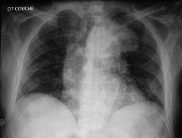 Case N 4 Man, 82 years old, no respiratory signs