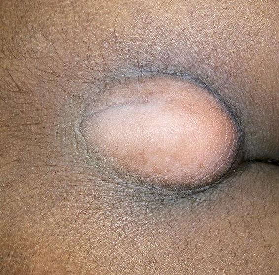 1. Photograph showing a solitary,smooth surfaced skin lined nodule