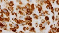 confirm Check serum calcitonin Hürthle cell neoplasm Neuroendocrine