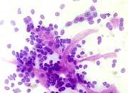 Pilomatrixoma Low grade malignant Basal cell adenocarcinoma Basal