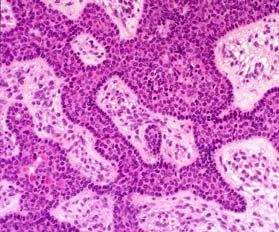 Basal cell adenoma/adenocarcinoma Cytologic features