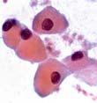 cytoplasm/mild cytologic atypia Oncocytic/clear