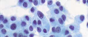 Papillary Mixed follicular and MTC Clear cell Small cell Giant cell (anaplastic) MTC Monotonous, dyshesive cells