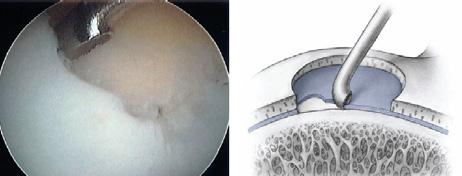 The function of the menisci is to protect the other type of cartilage in the knee the articular cartilage.
