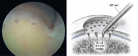 Figure 4 Arthroscopic image (Figure 4-A) and drawing (Figure 4-B) demonstrating the adequate depth of subchondral bone penetration and width of osseous bridges between the individual microfracture