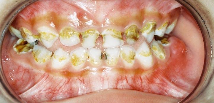 Tooth decay Most common disease for children worldwide Multifactorial disease with a strong social gradient Early onset with first teeth - lifelong problems with