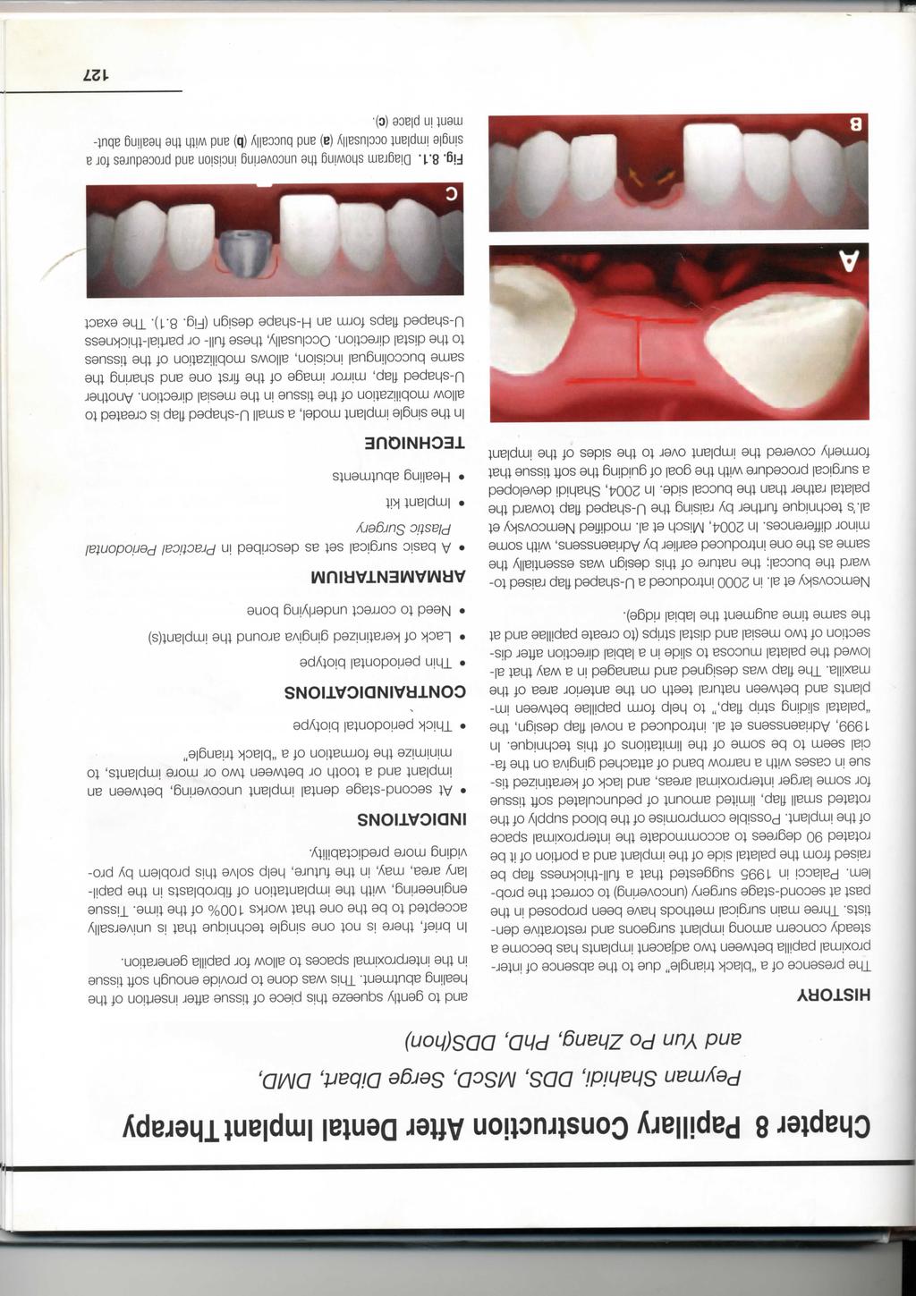 Chapter 8 Papillary Construction After Dental Implant Therapy Peyman Shahidi, DOS, MScD, Serge Dibart, DMD, and Yun Po Zhang, PhD, DDS(hon) HISTORY The presence of a "black triangle" due to the