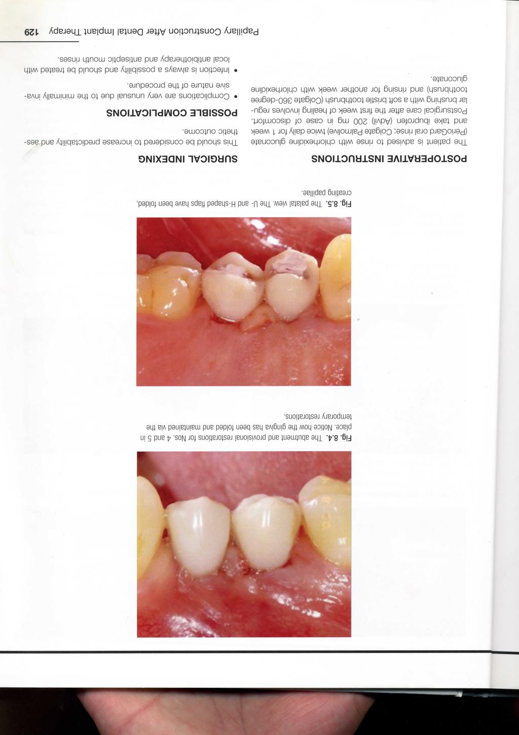Fig. 8.4. The abutment and provisional restorations for Nos. 4 and 5 in place. Notice how the gingiva has been folded and maintained via the temporary restorations. Fig. 8.5. The palatal view.