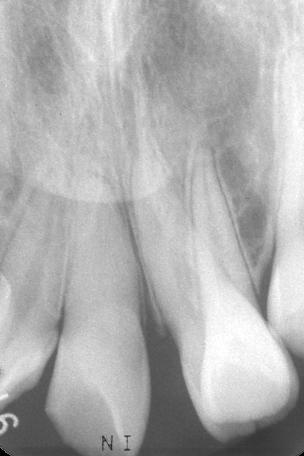 At the 6-year followup examination, the teeth remained asymptomatic, pulpal response to sensitivity tests was normal, and radiographic evidence of healing was demonstrated (Figures 7d and 8).