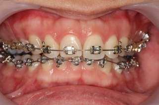 Differential Diagnosis of Gummy smile Supereruption