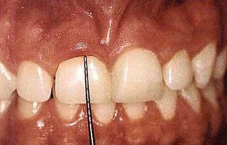 Short clinical crown Average length of upper central Male: incisors 10.6 mm Female: 9.