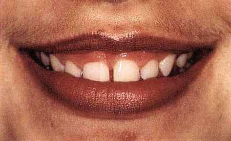 T. Hard- and soft-tissue contributions to the esthetics of the posed smile in growing
