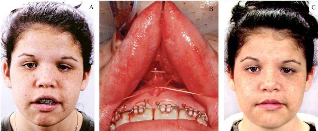 V-Y Cheiloplasty to lengthen the short upper lip Dynamic smile visualization and quantification: Part 1.