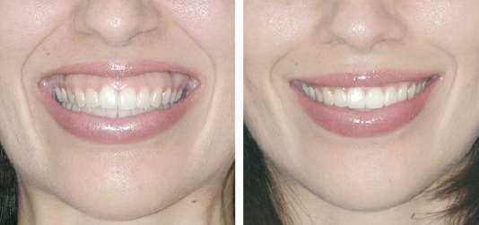 correction of excessive gingival display on smiling,