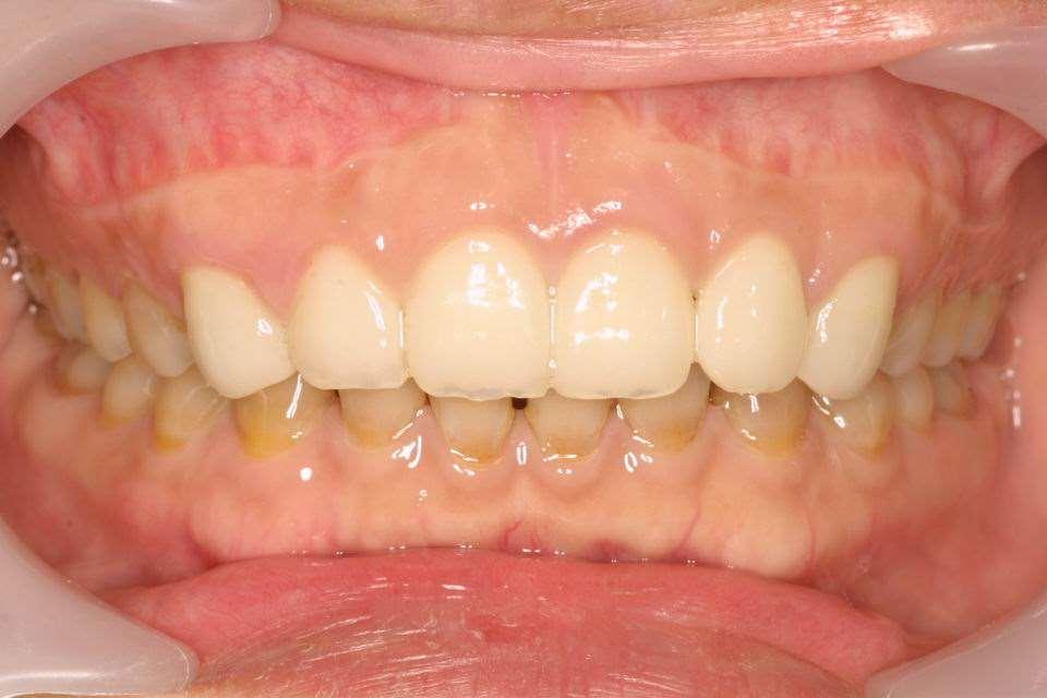 Upper incisor