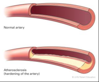 Why did the artery get narrow or blocked? Over time, a fatty material called plaque has built up inside your arteries. This process is called atherosclerosis (hardening of the arteries).