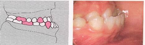 the upper jaw Mesialocclusion (regarding