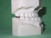 Properties: Disorders in Angle Class III Big mandible, expressed tip of the chin Upper front region is tilted labially Lower