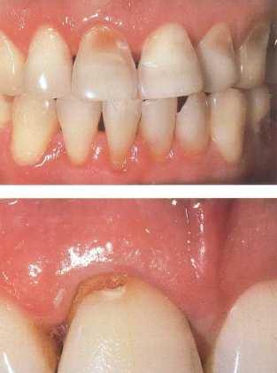 Anterior Restorations Abfraction Abrasion Caries with loss of enamel Caries with Dentin Involvement Crown Repair Acid Erosions 10 Closely matching natural teeth with an artificial restoration can be