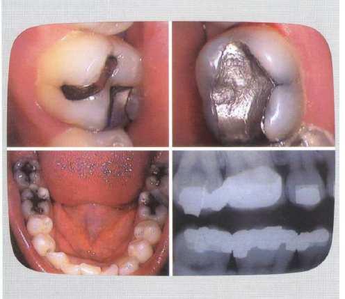 Intraoral Camera Diagnosis & Treatment Planning 'pockets,' 'plaque deposits' and 'abscesses'.