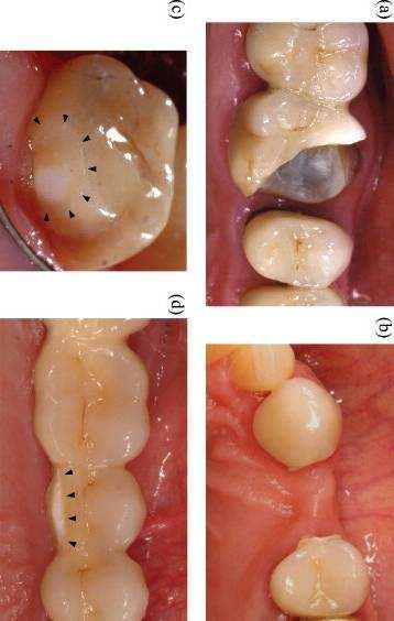 Materials and Prosthodontics Shade selection procedure depends on various factors including translucency, contour and surface texture The impact of the color science can be seen on various