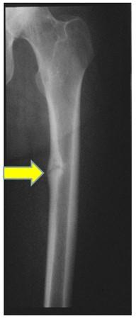 deformation/fracture) Rickets is essentially the same problem (only