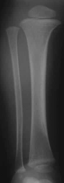 Anatomy of a long bone Knee joint Epiphysis Physis Metaphysis