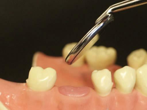 You should be able to see the margins created on the mesial and distal