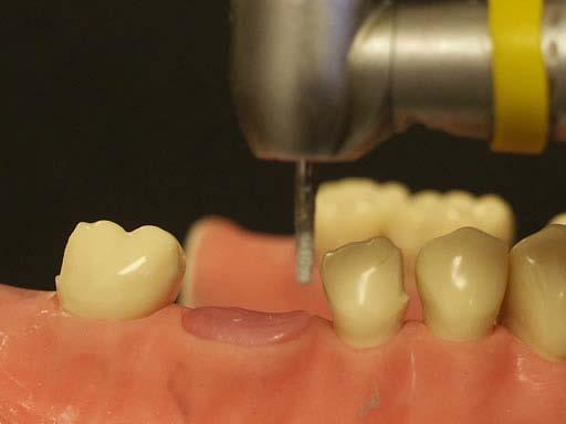 Distal proximal reduction of the more anterior abutment Instructor s Note Preparing teeth to receive a fixed partial denture requires establishment of one common path of insertion for the abutment
